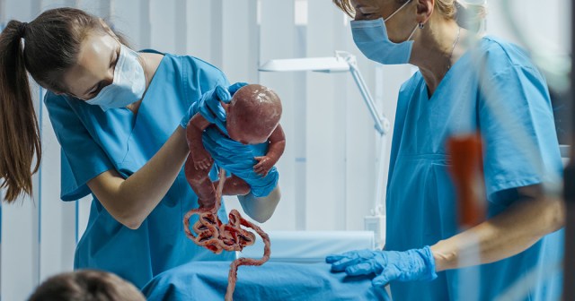 Lazy Obstetrician Just Pulling On Baby Until Umbilical Cord Untangles