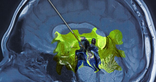 Cyberpunk 2077 Runs Great When Injected Into Your Brain With a Large Syringe, But This Is No Indicator for Console