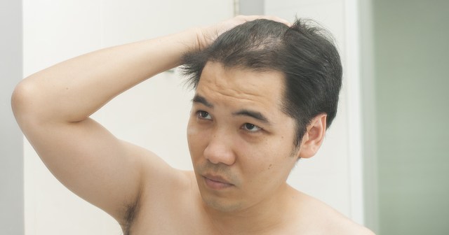 Guy Grows Hair Out Just in Time to Start Losing It