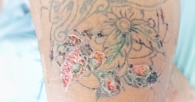 Dead Punk Identified By Tattoo Infections