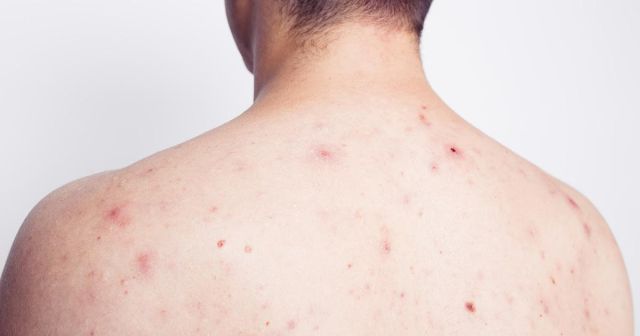 Acne Launches New Franchise Opportunities Across Upper Back and Shoulders