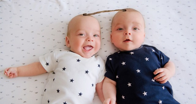Nu-Metal Conjoined Twins Born Connected by Dreadlock