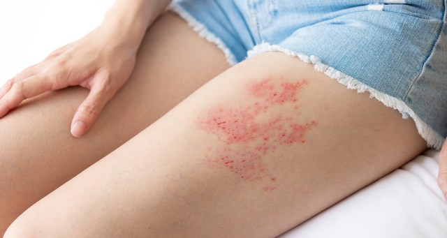 Dry Hump Rash Spreads Through Christian Music Festival